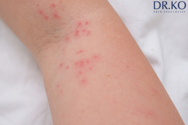 Scabies treatment Malaysia – Leading Skin and Aesthetic Clinic in Malaysia