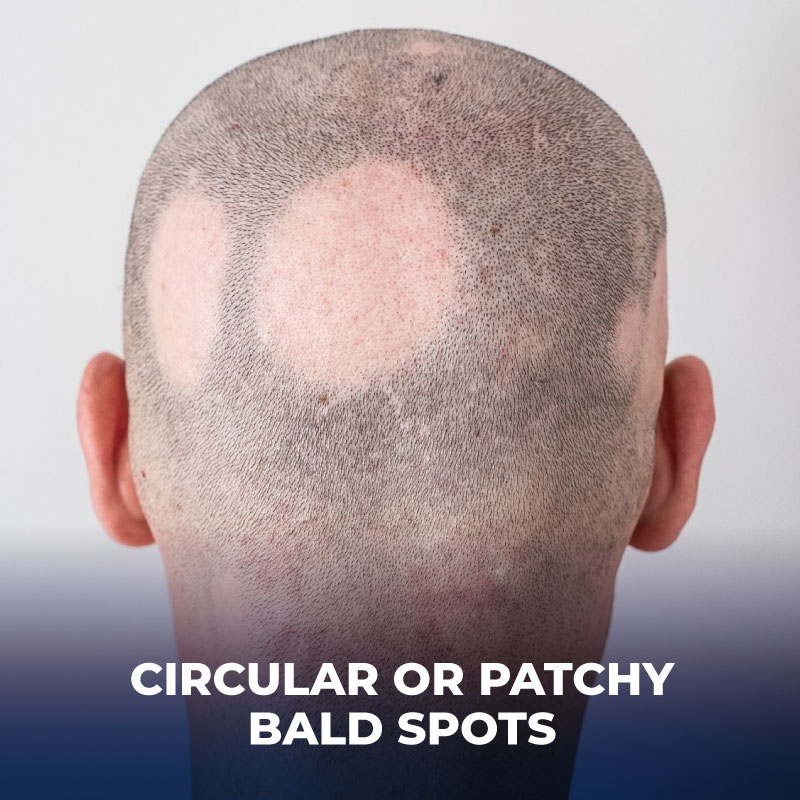 bald-spots-2