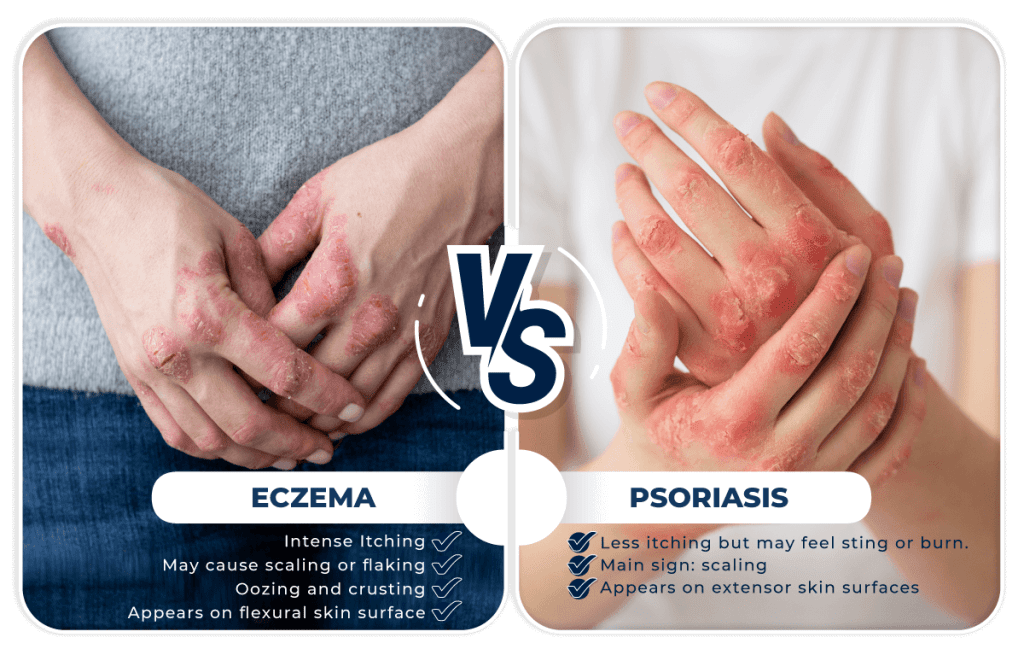 Recurring Eczema Same Spot