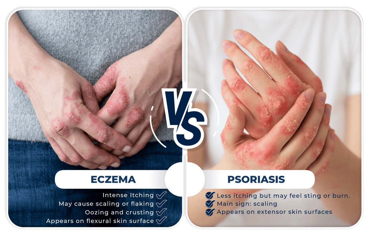 Eczema Vs Psoriasis 2 