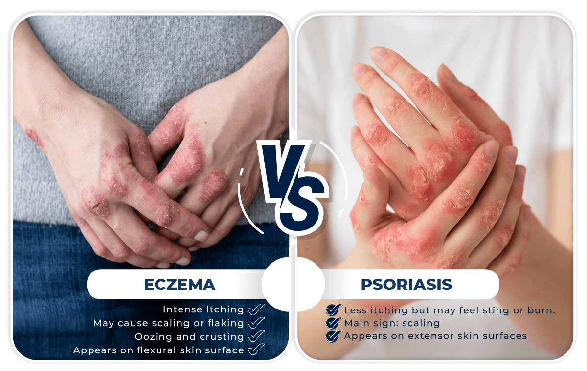 Eczema Vs Psoriasis Eczema Vs Psoriasis