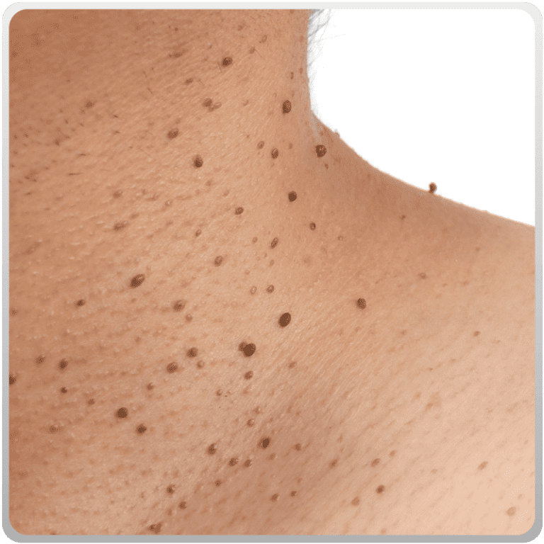 Benign skin growth/skin tag - Ko Skin Specialist