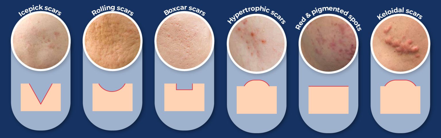 acne-scar-scar-pore-ko-skin-specialist