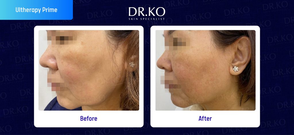 Ultherapy Prime Before and After