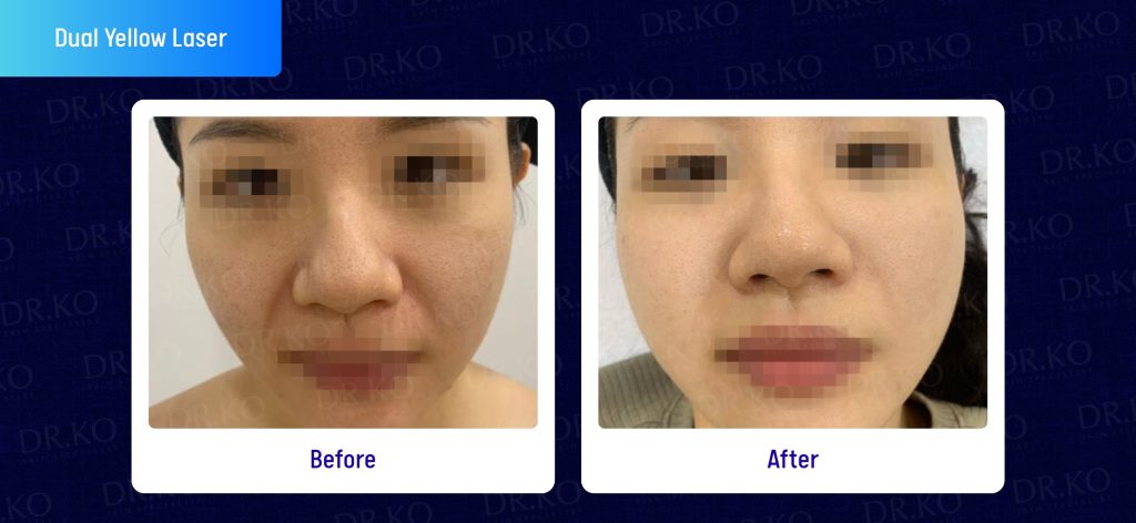 dual yellow laser before and after