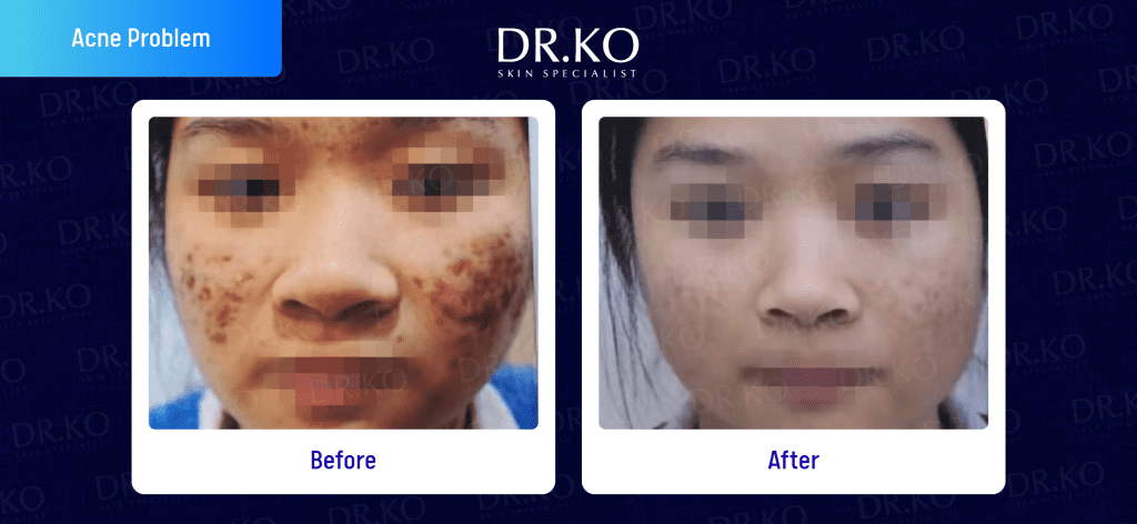 Acne Treatment Before & After: Real Patient Results at Dr Ko (Female patient)