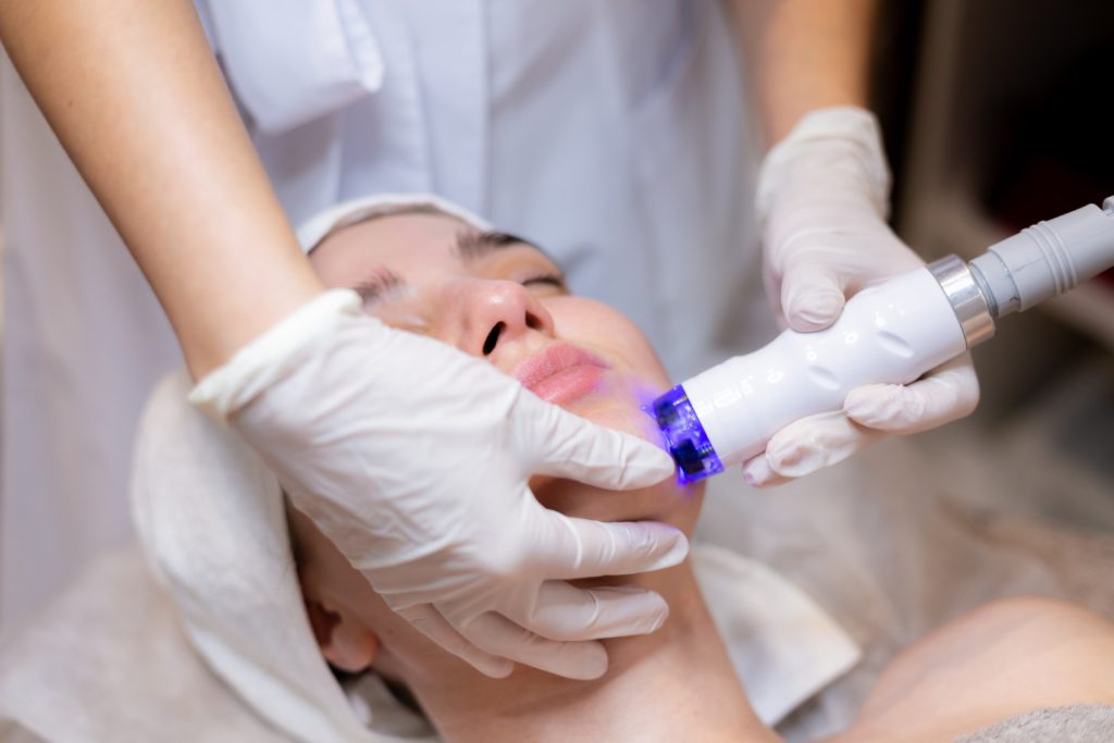 Laser Therapy for Acne