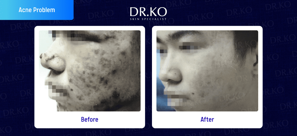 Acne Treatment Before & After: Real Patient Results at Dr Ko (Male patient)