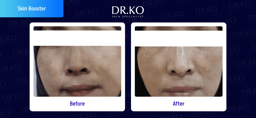 Skin Booster Before & After Results: Real Patient Cases (Female)