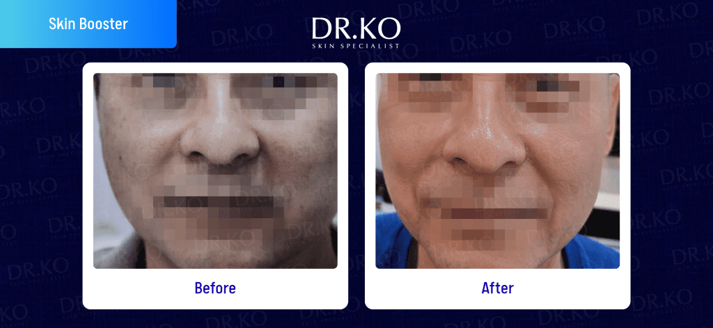 Skin Booster Before & After Results: Real Patient Cases (Male)