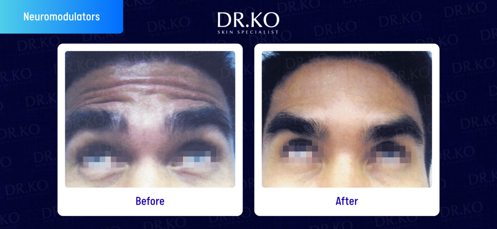 Before and After Botox Treatment at Dr Ko Skin Specialist