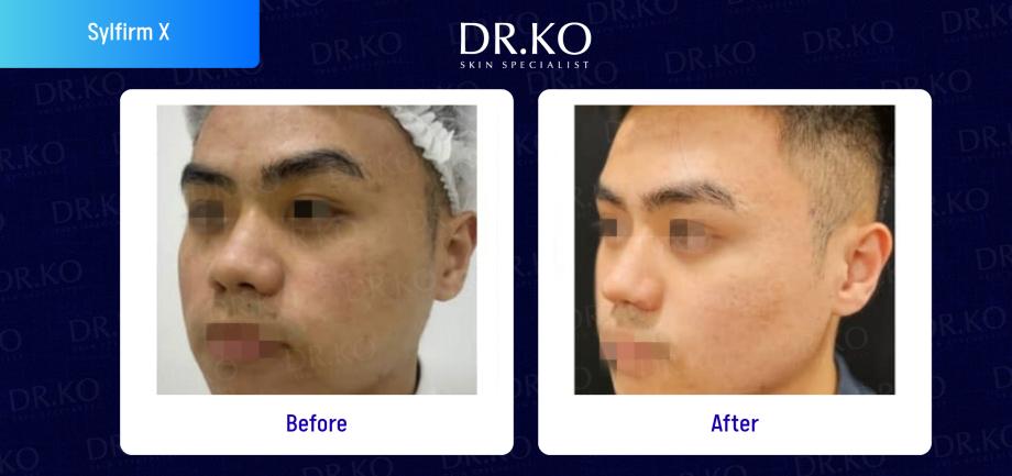 Before & After Results Real Patient Cases 1 RF Microneedling