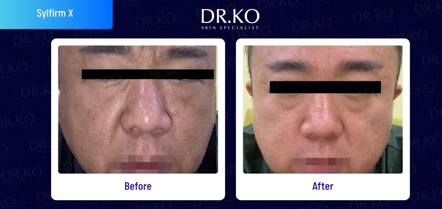 Before & After Results Real Patient Cases 2 RF Microneedling