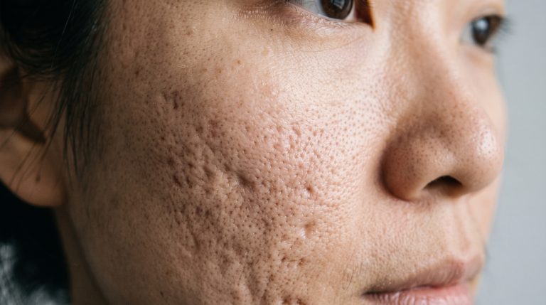 acne scars