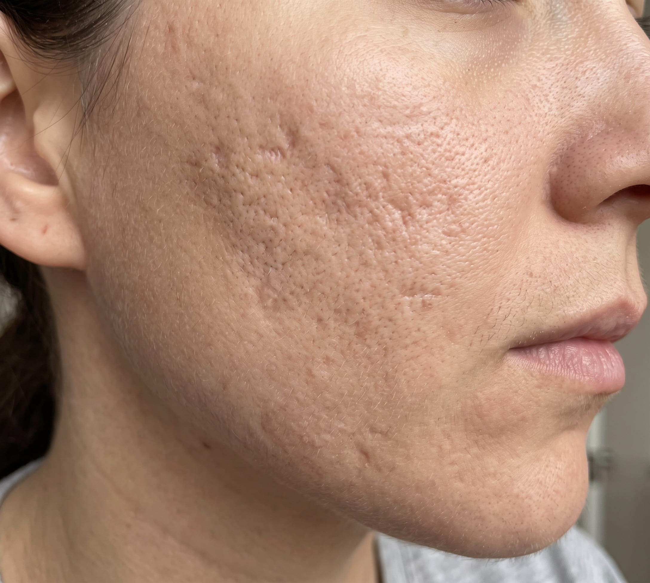 acne scars facial condition