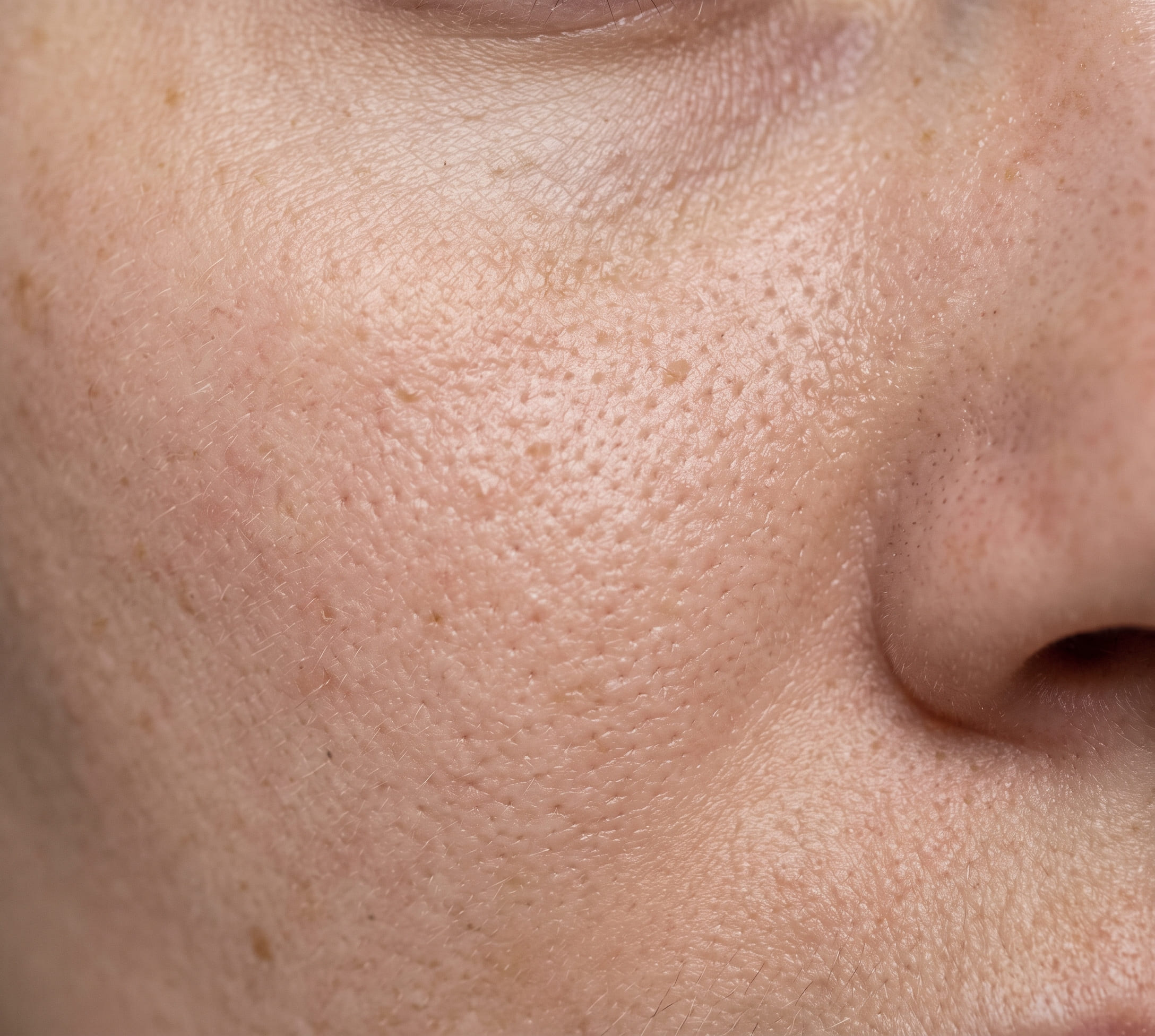 enlarged pores and texture