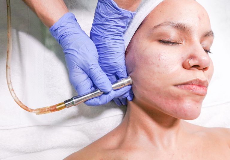 microdermabrasion procedure