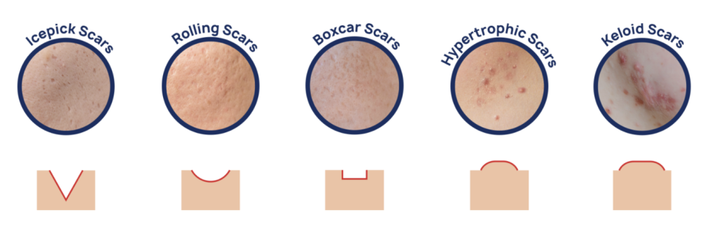 type of acne scars