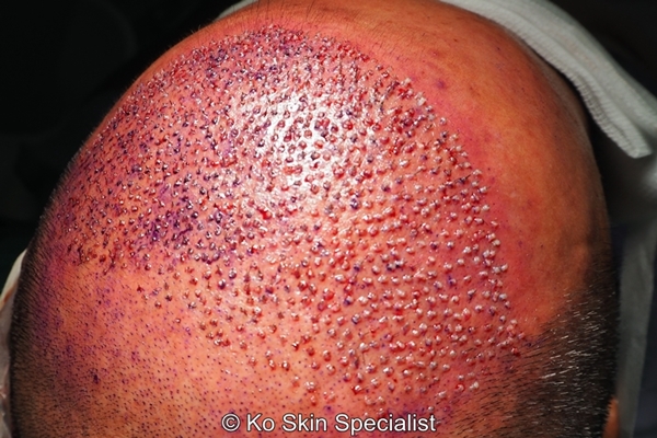 not-for-tryphophobes-scalp-after-hair-transplant-7